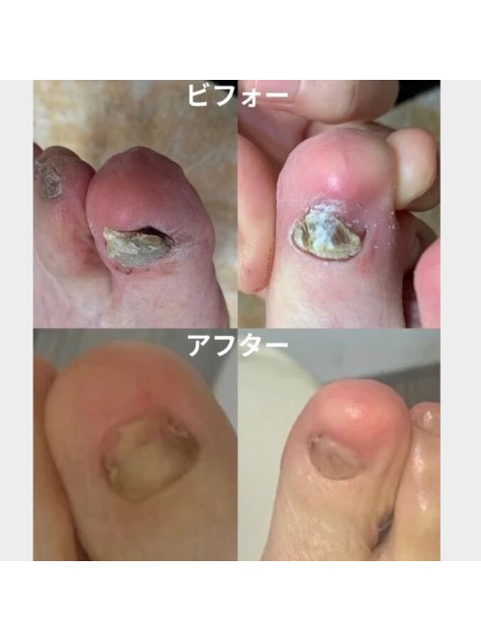 フットケア蘇 SO の巻き爪ケア写真
